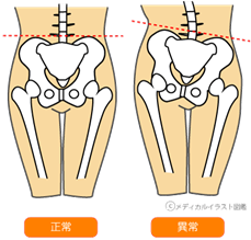 骨盤歪み