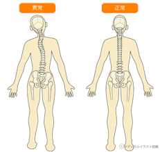 背骨歪み